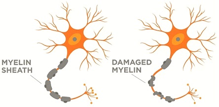 Multiple Sclerosis